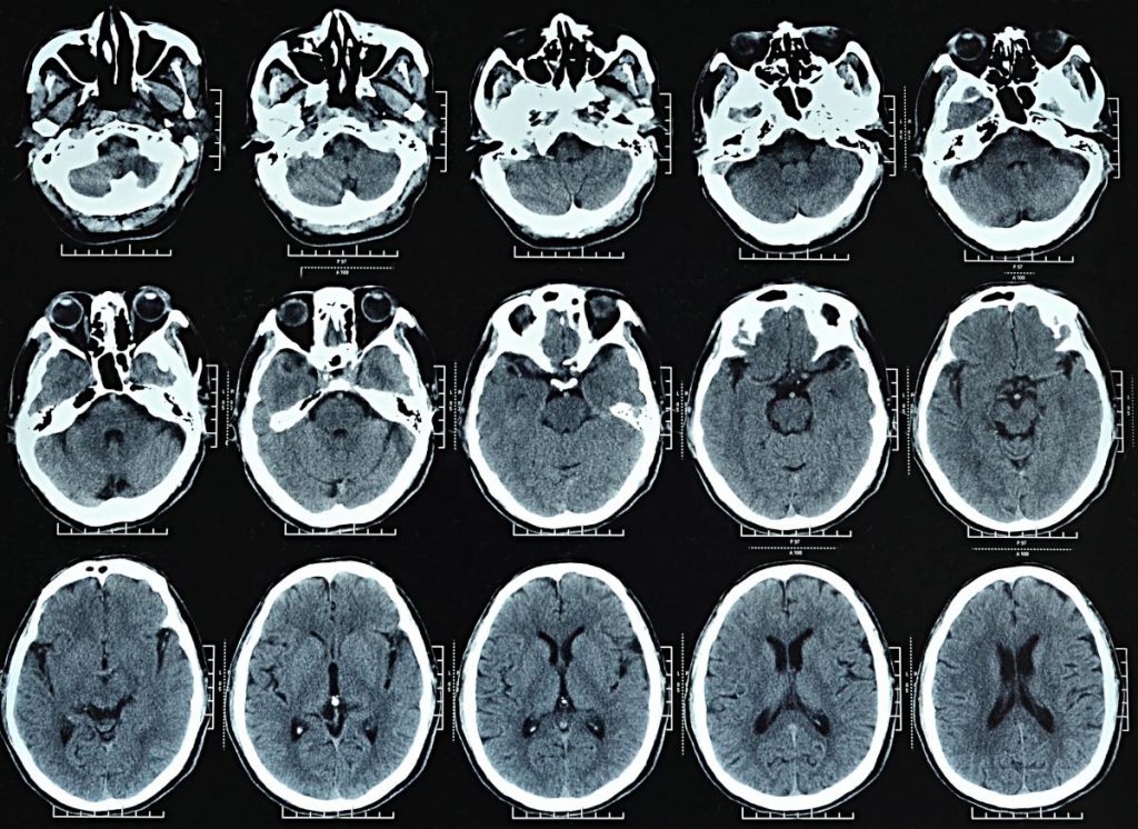 When a CT scan is performed on a patient